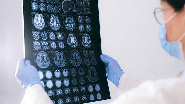 How long does a concussion last?